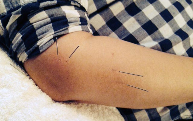electro-stimulation dry needling for runners knee